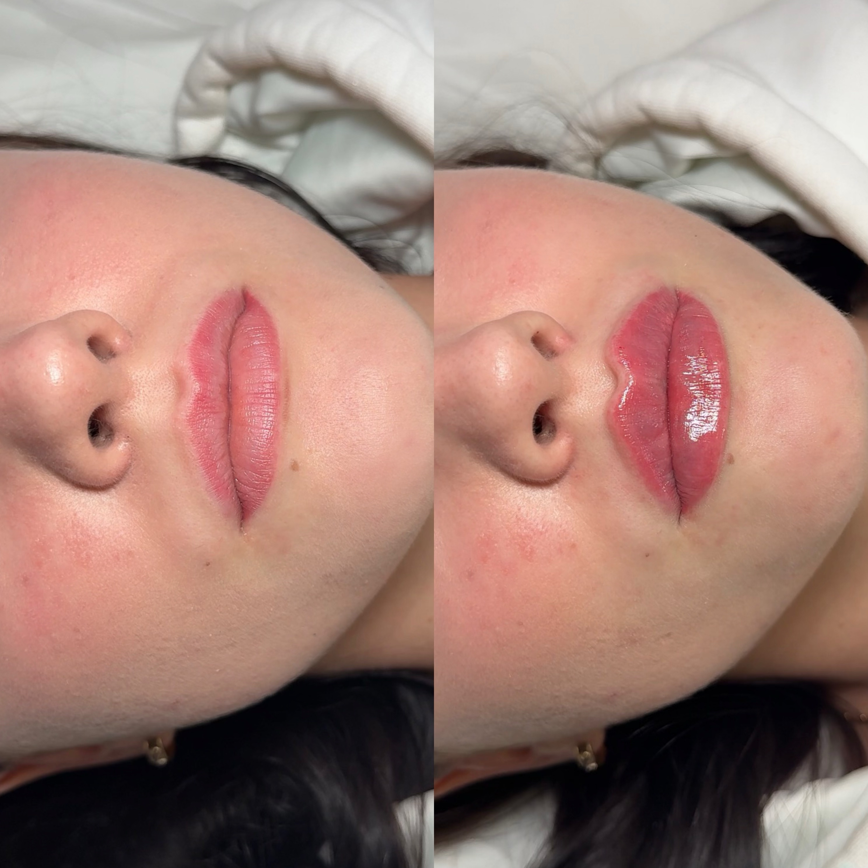 Lip Augmentation · Before & After