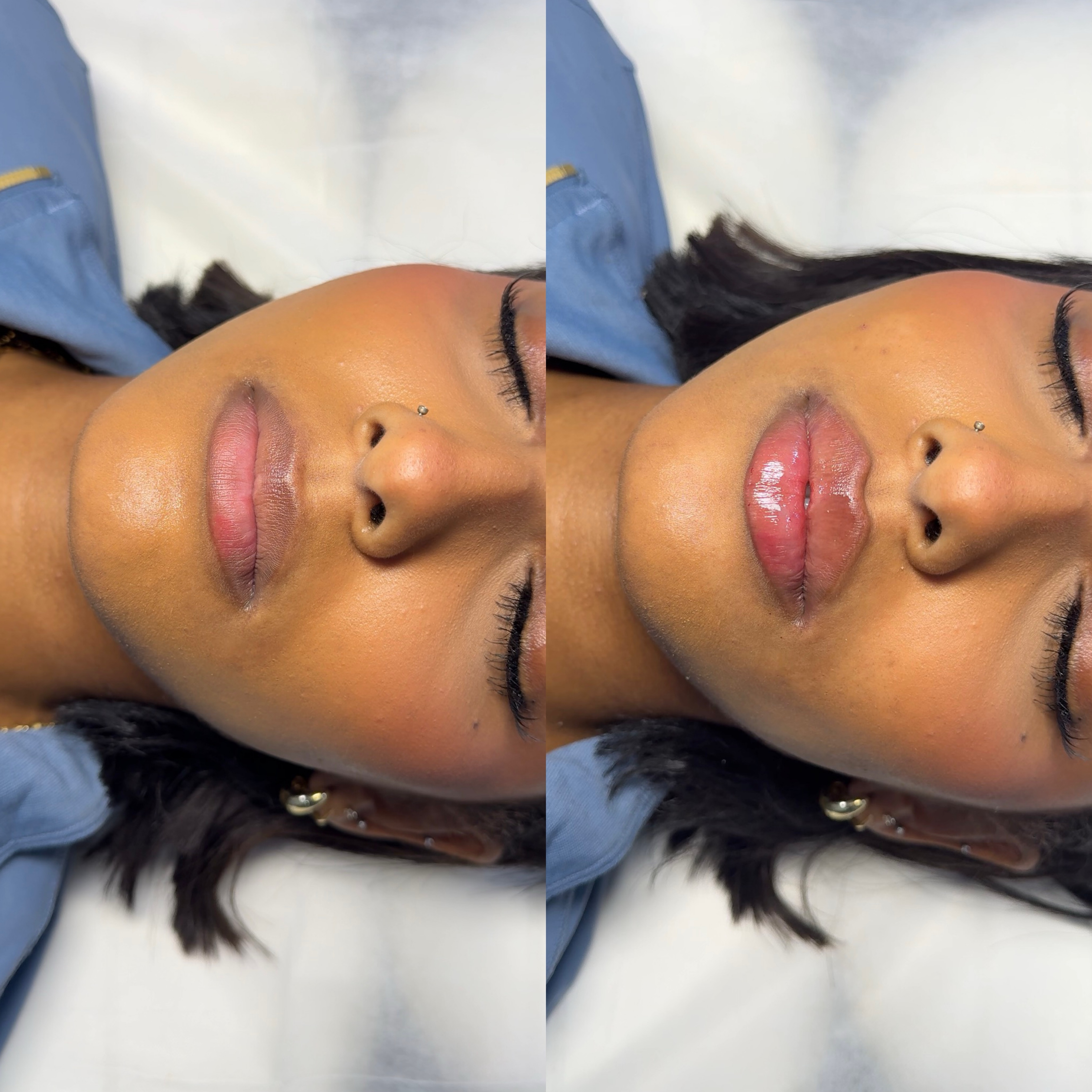 Russian Lips · Before & After