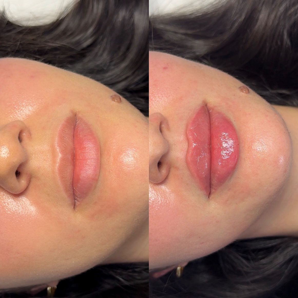 Lip Filler · Before & After